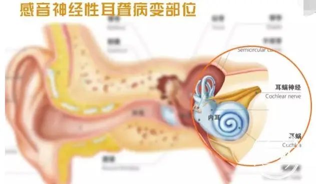 感音神经性耳聋能治吗？有哪些病症？【六一儿童医院耳科】