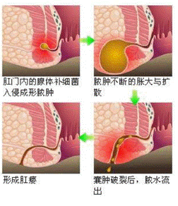 广州东大肛肠医院：肛门突然疼痛怎么办，5个注意事项不要忘！